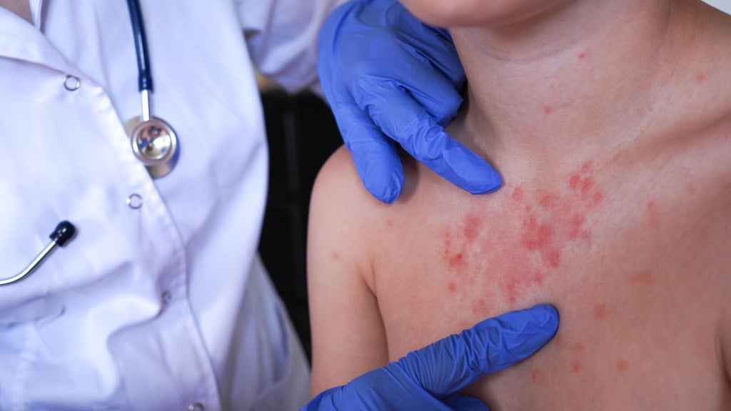 Minnesota's 80 measles cases this year are the most since 1990, health officials say — Duluth Health news
